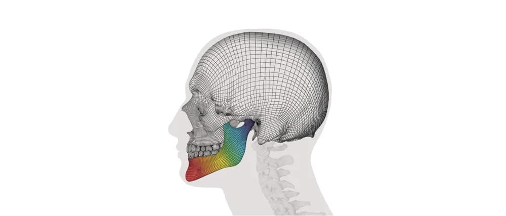 IPS inSilico® — Individual implant yechimi (CMF)